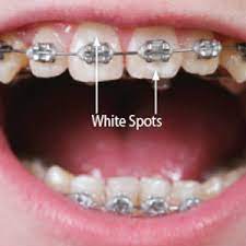 White Stains on Teeth